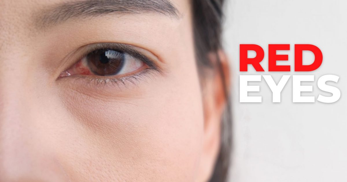 The 10 Most Common Reasons for Red Eyes EZOnTheEyes