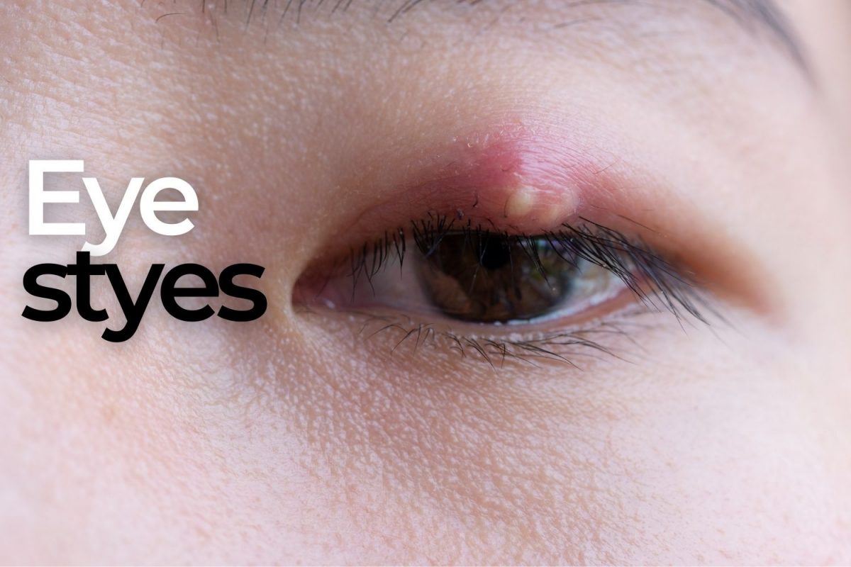 How to Treat a Stye on Your Eyelid EZOnTheEyes