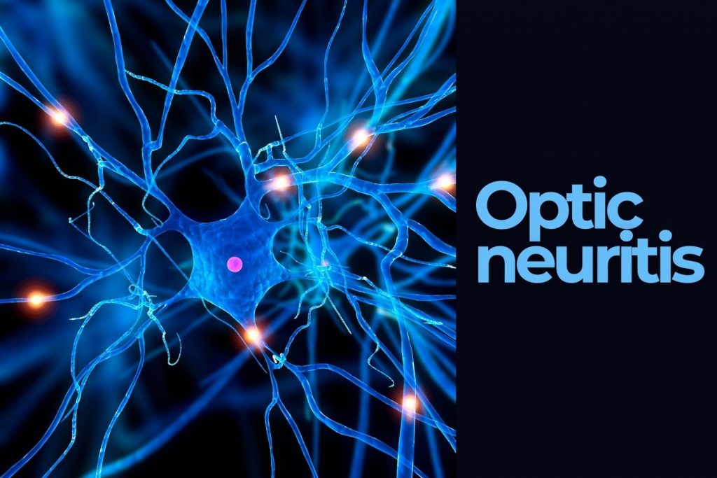 What is Optic Neuritis and How is it Connected to MS? EZOnTheEyes