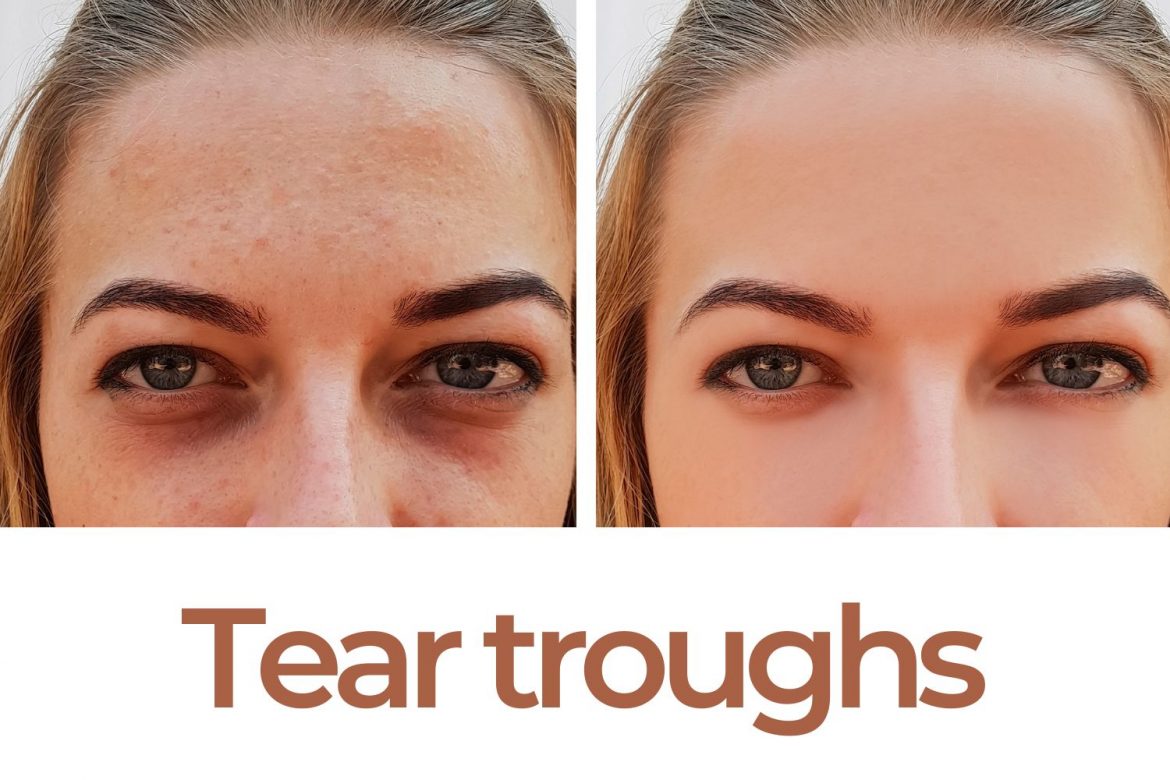 tear troughs
