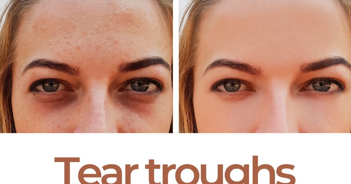 Tear Troughs Causes and Treatment Options EZOnTheEyes