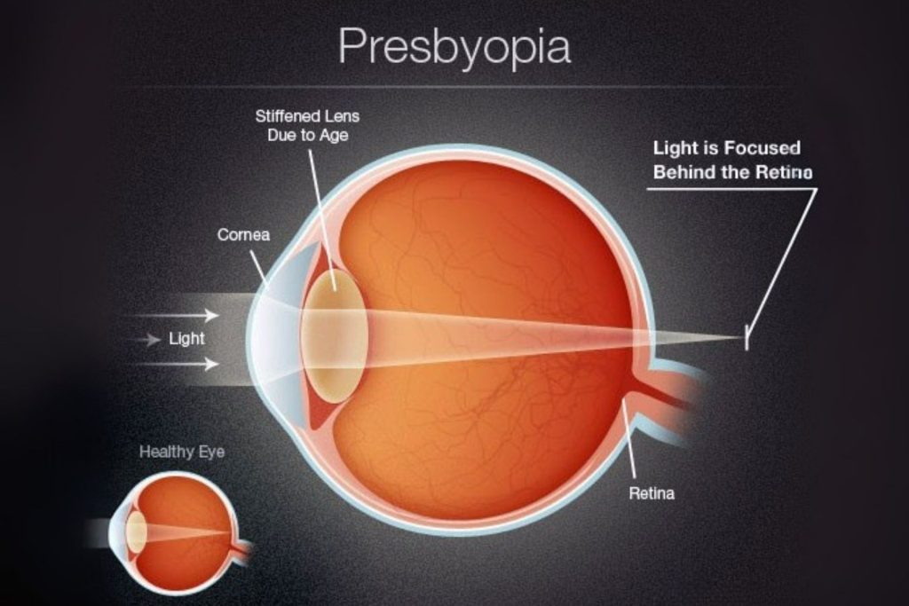 Presbyopia explainer