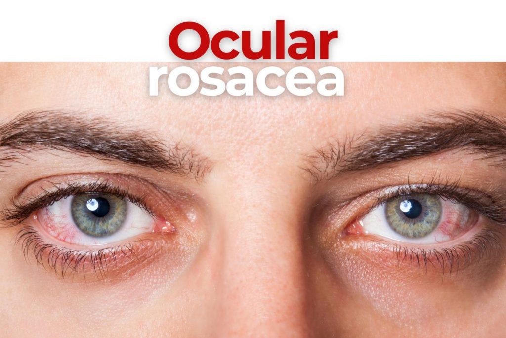Man with ocular rosacea