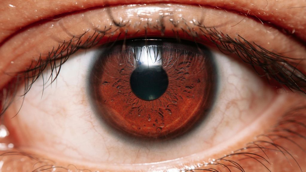 Closeup of an irritated eye with visible red sclera