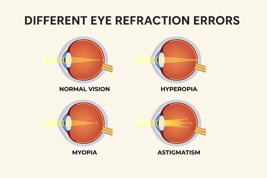Illustration of refractive errors: normal vision, hyperopia, myopia, astigmatism
