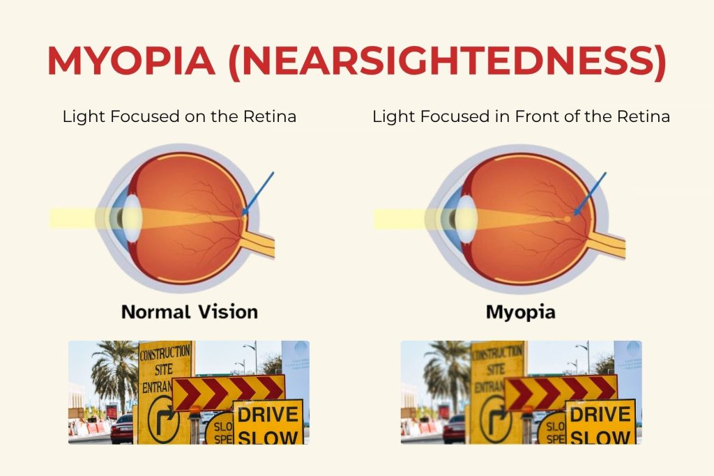 An illustration depicting how myopia (with a focal point in front of the retina) differs from normal vision (focal point directly on the retina)
