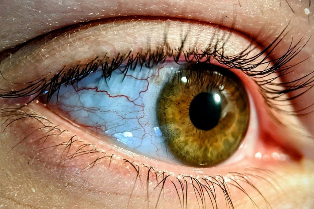 Woman with eye strain and red veins