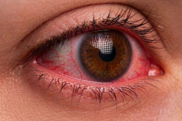 Why Do My Eyes Get Red With Contacts?