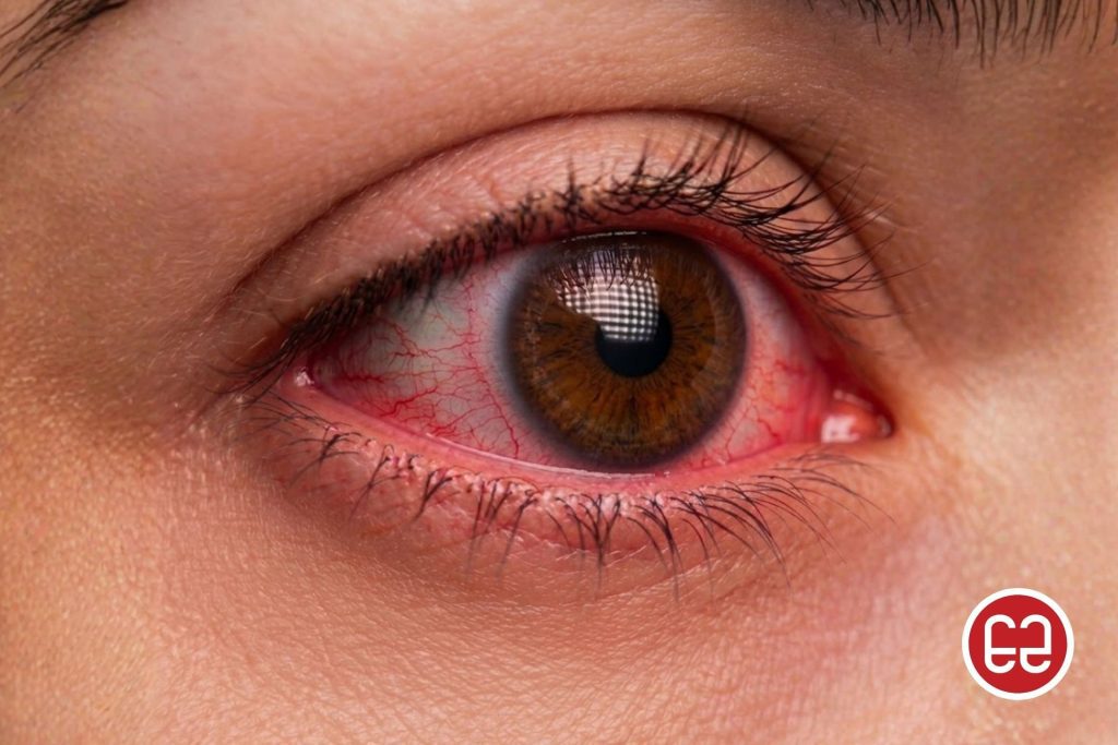 An eye with redness