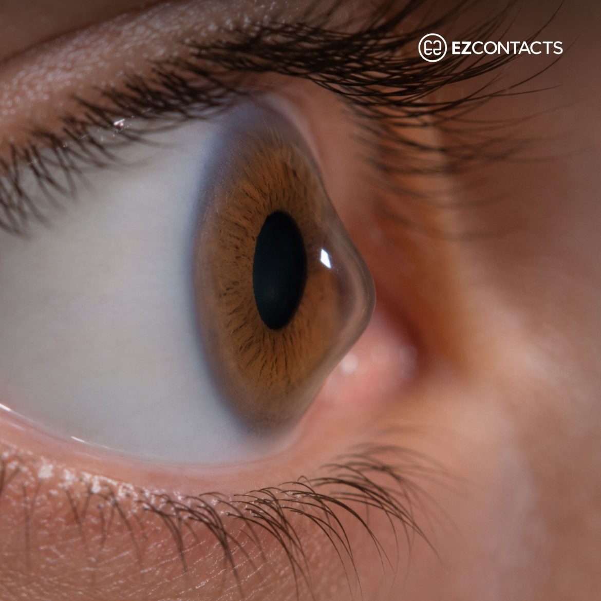 Close-up of an eye with keratoconus