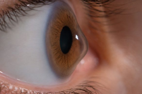 What Are Keratoconus Symptoms? What To Look Out For