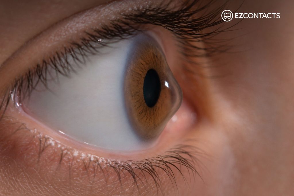Close-Up on the eye of a person with keratoconus

