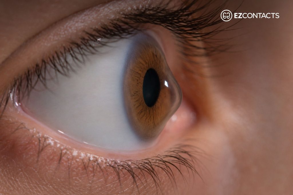 Close-Up on the eye of a person with keratoconus
