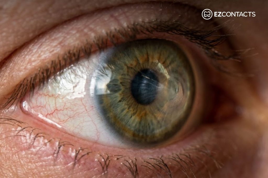 Close-up of an eye with keratoconus