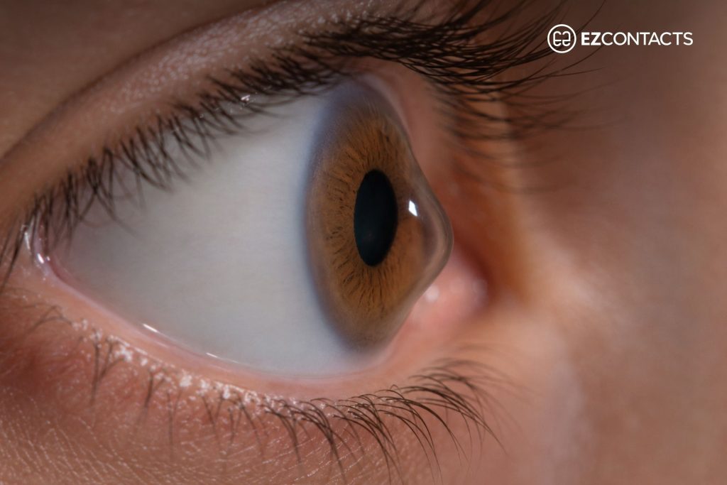 Eye With Keratoconus