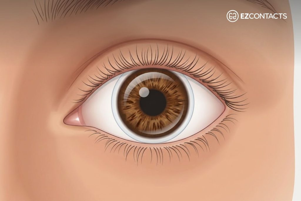 Eye With a Contact Lens Covering the Iris and a Small Part of the Sclera