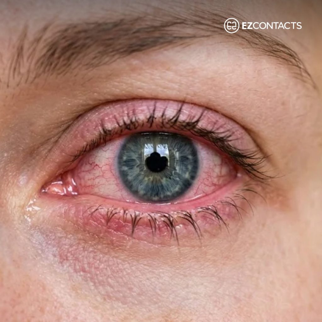 Pink Eye and Contacts Featured