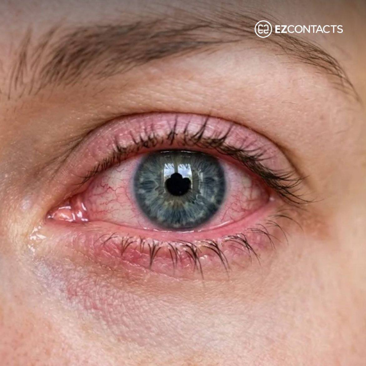 Pink Eye and Contacts Featured