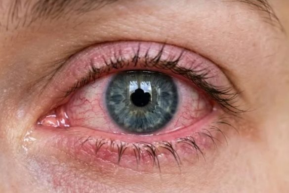 Pink Eye and Contacts: What Now?
