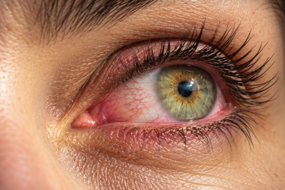 What Are Systane Eye Drops Used For?